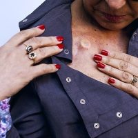 L'ouverture des boutons-pression de la version chemise du vêtement spécial chimio pour femme atteinte d'un cancer